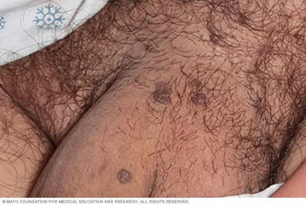Virus del Papiloma Humano (VPH): Síntomas, Riesgos y la Importancia de Atenderse a Tiempo